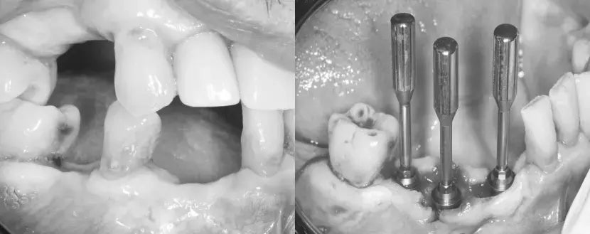Multi Unit Abutment for Partial Arch Replacement