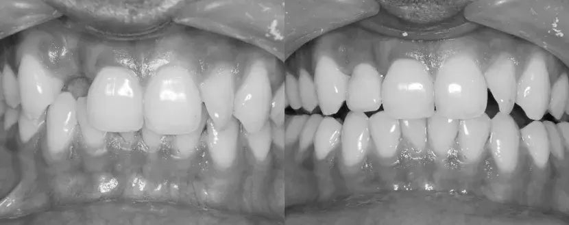 Single Implant Case: Missing Lateral Incisor